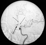 Аневризма передней соединительной артерии при ангиографии