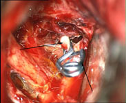 Клипирование аневризмы передней соединительной артерии