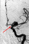 Клипирование аневризмы левой внутренней сонной артерии: церебральная ангиография до операции