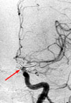 Клипирование аневризмы левой внутренней сонной артерии: церебральная ангиография после операции