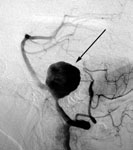 Эмболизация аневризмы базилярной артерии: ангиография до операции