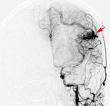 Применение нейронавигации в хирургии АВМ: АВМ при каротидной ангиографии