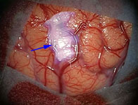 Применение нейронавигации в хирургии АВМ: виртуальная проекция внутримозговой гематомы на кору головного мозга