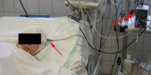 Удаление гематомы, иссечение АВМ и установка паренхиматозного датчика внутричерепного давления: мониторинг внутричерепного давления после операции