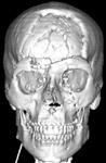 3D КТ: множественные переломы костей черепа