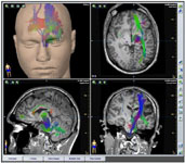 трехмерная модель головного мозга с трактографией