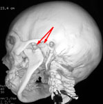 КТ: травматическая деформация мыщелка левого суставного отростка нижней челюсти