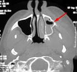 КТ: повреждение левой верхнечелюстной (гайморовой) придаточной пазухи носа