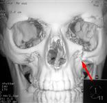 КТ: травматическая деформация левой глазницы – скулоорбитального комплекса