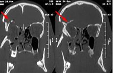 Повреждение правой глазницы: КТ в коронарной проекции до операции