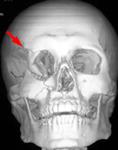 Повреждение правой глазницы: КТ 3D до операции