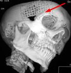 Повреждение правой глазницы: КТ после операции