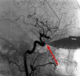 Ангиограмма черепа с ножом