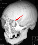 Инородное тело (армированное стекло) левой глазницы: КТ до операции