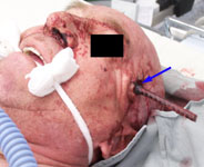 Колотая рана головы, проникающая в полость передней черепной ямки: больной перед операцией