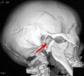 КТ: одиночный перелом одной кости – перелом со смещением правого мыщелкового отростка нижней челюсти
