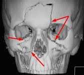 Множественные переломы костей лица: 3D КТ в прямой проекции