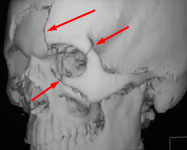 Множественные переломы костей лица: 3D КТ в боковой проекции