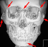 Множественный перелом костей лицевого и мозгового черепа: 3D КТ в прямой проекции
