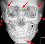 Множественный перелом костей лицевого и мозгового черепа: 3D КТ в прямой проекции