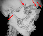 Множественный перелом костей лицевого и мозгового черепа: 3D КТ в боковой проекции