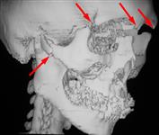 Множественный перелом костей лицевого и мозгового черепа: 3D КТ в боковой проекции