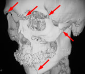 Множественный перелом костей лицевого и мозгового черепа: 3D КТ в боковой проекции