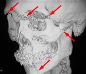 Множественный перелом костей лицевого и мозгового черепа: 3D КТ в боковой проекции