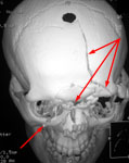 Множественная черепно-лицевая травма: КТ в передне-верхней проекции до операции