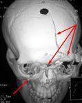 Множественная черепно-лицевая травма: КТ в передне-верхней проекции до операции
