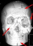 Множественная черепно-лицевая травма: КТ после 1-го этапа хирургического лечения