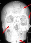 Множественная черепно-лицевая травма: КТ после 1-го этапа хирургического лечения