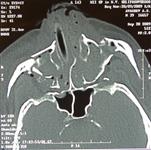 Множественная черепно-лицевая травма: КТ в аксиальной проекции