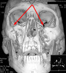 Перелом мыщелковых (суставных) отростков нижней челюсти: 3D КТ