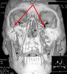 Перелом мыщелковых (суставных) отростков нижней челюсти: 3D КТ