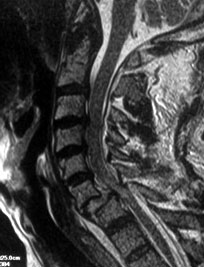 Реабилитация после травм спины (спинного мозга)