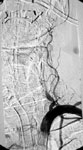 Окклюзия левой позвоночной артерии при ангиографии