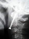 Трансдентальная фиксация перелома зубовидного отростка С2 позвонка при рентгенографии