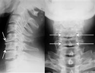 Дегенеративно-дистрофическое поражение шейного отдела позвоночника и секвестрированная грыжа диска С5-6: рентгенограмма в боковой и прямой проекции