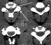 Дегенеративно-дистрофическое поражение шейного отдела позвоночника и секвестрированная грыжа диска С5-6: КТ в аксиальной проекции