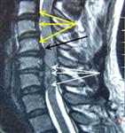 Дегенеративно-дистрофическое поражение шейного отдела позвоночника и секвестрированная грыжа диска С5-6: МРТ в сагиттальной плоскости