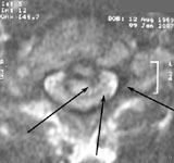 Дегенеративно-дистрофическое поражение шейного отдела позвоночника и секвестрированная грыжа диска С5-6: МРТ в аксиальной плоскости