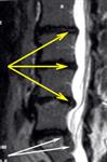 МРТ поясничного отдела позвоночника в Т2 режиме в сагиттальной проекции