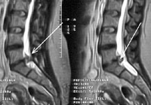 Больная после микрохирургического удаления левосторонней секвестрированной грыжи диска L5-S1 и полным выздоровлением: МРТ в сагиттальной проекции до операции