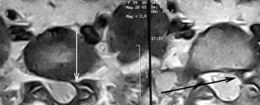 Больная после микрохирургического удаления левосторонней секвестрированной грыжи диска L5-S1 и полным выздоровлением: МРТ в аксиальной проекции через год после операции