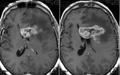 Удаление глиобластомы лобных долей и колена мозолистого тела: МРТ до операции